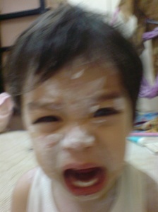 faatih with calamine lotion